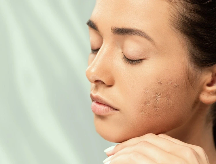 سابسیژن یک روش درمانی برای برطرفکردن فرورفتگیهای پوستی است