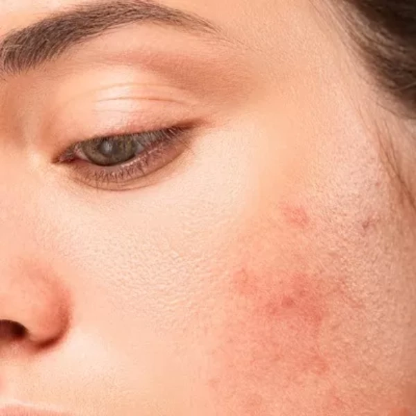 سابسیژن صورت