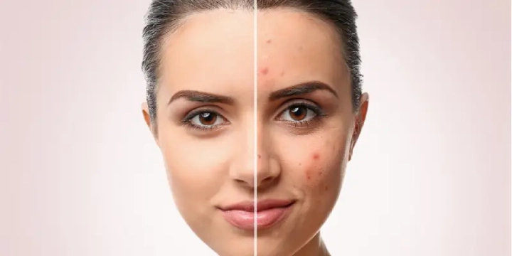 عوارض سابسیژن معمولاً خفیف، موقتی و قابلکنترل هستند