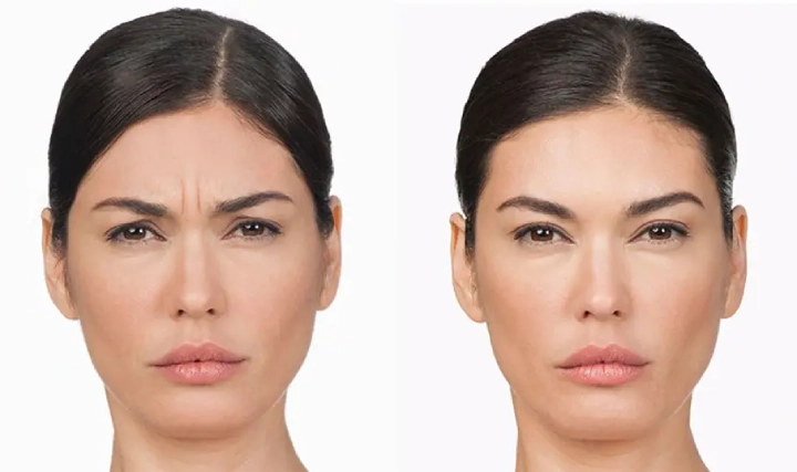 تزریق بوتاکس در کلینیک زیبایی واو