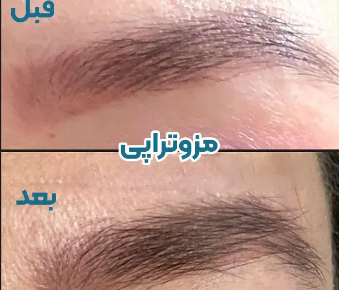 مزوتراپی ابرو چیست
