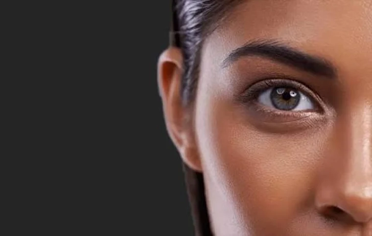 لیفت چشم گربه ای با بوتاکس