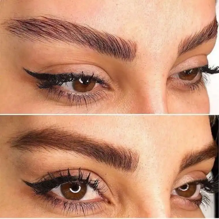 کاربرد بوتاکس ابرو برای افتادگی ابرو
